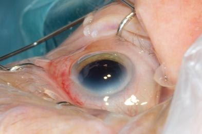 Treatment of cataracts | GPonline