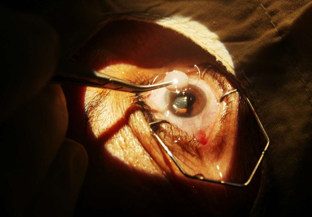 cataracts surgery