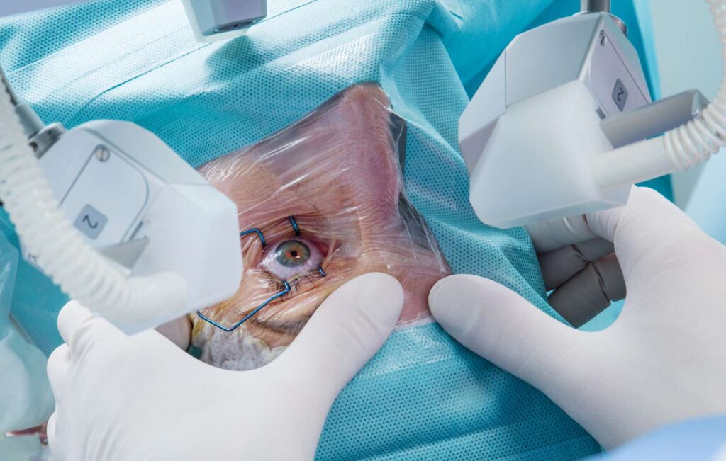 Everything You Need to Know About Cataract Surgery